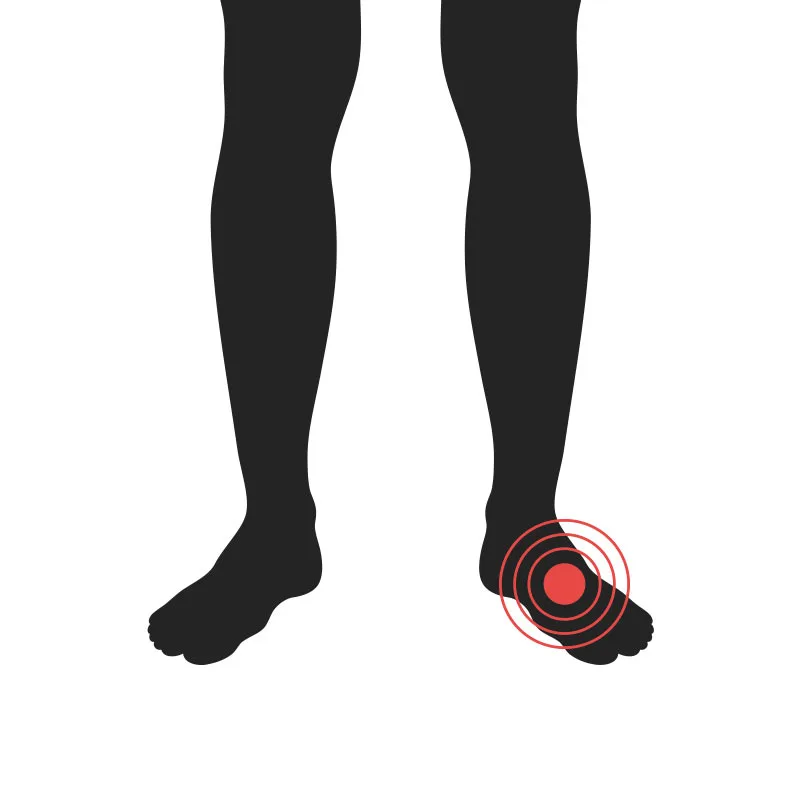 Fótur - Algeng meiðsli - Sjúkraþjálfun Kópavogs