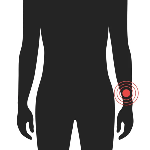 Hönd - Algeng meiðsli - Sjúkraþjálfun Kópavogs